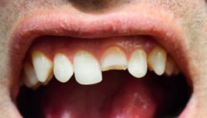 почему откалываются зубы